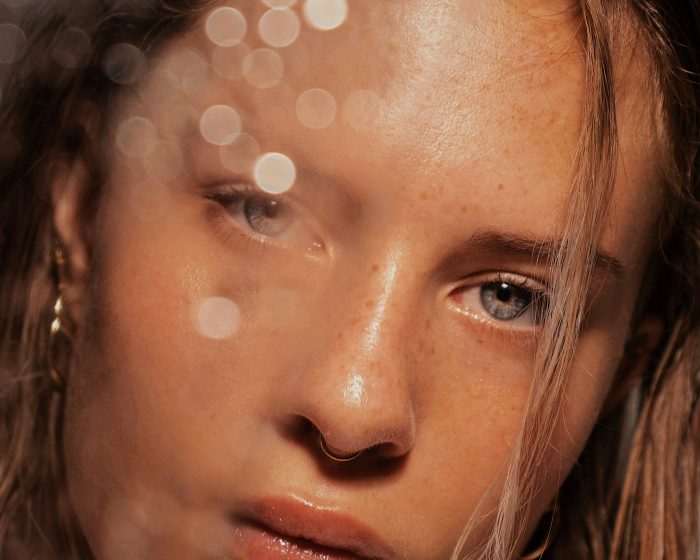 Blemishes & Hyperpigmentation